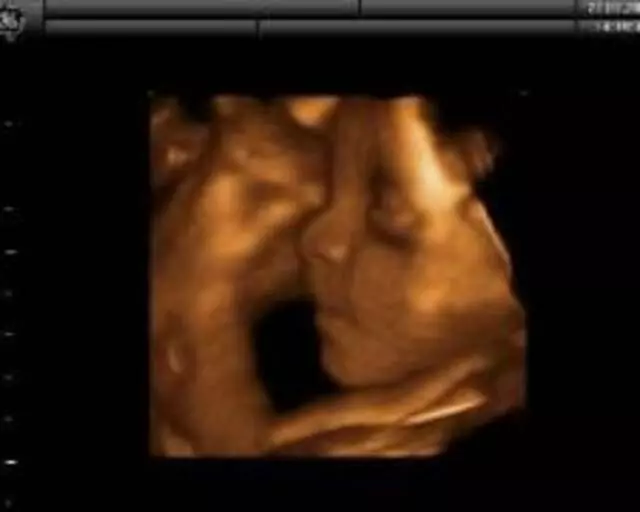Mirror Imaging Ultrasound