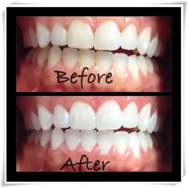30 Minute Teeth Whitening