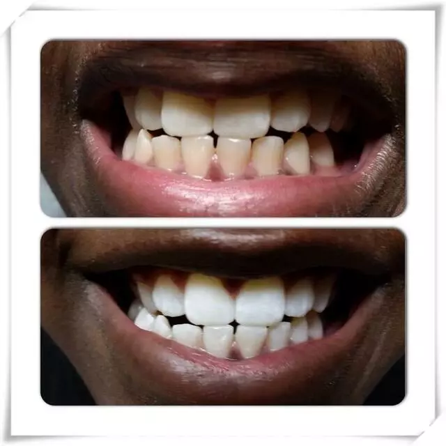 30 Minute Teeth Whitening